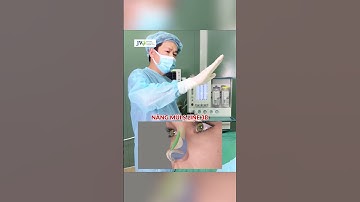 Bác sĩ Tú Dung NÂNG MŨI cấu trúc S Line 3D đẹp tê tái