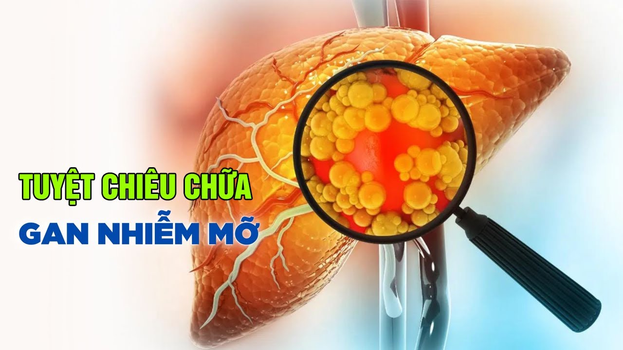TUYỆT CHIÊU CHỮA TRỊ GAN NHIỄM MỠ