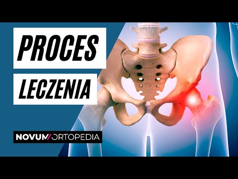 Endoprotezoplastyka stawu biodrowego - rola ortopedy w procesie leczenia. | Novum Ortopedia