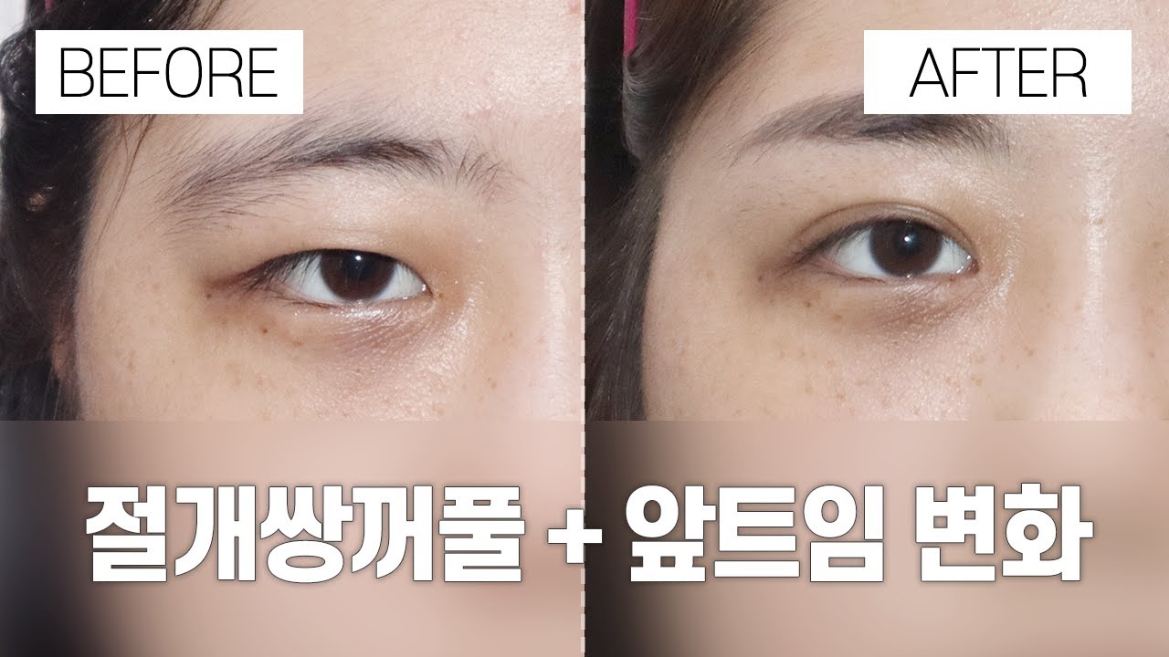 [Ганнам Соён гоо сайхны мэс заслын эмнэлэг] Нүдний гоо сайхны мэс засал өмнө ба дараа | Зүсэлттэй давхар зовхи, нүдний дотор булан нээх мэс заслын өмнө, дараах ялгаа
