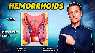 The #1 Best Remedy for Hemorrhoids  Dr. Berg