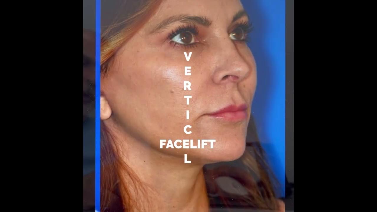 Facelift secret the vertical vector YouTube
