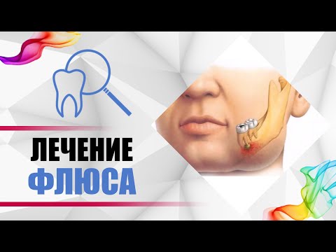 Видео: Являются ли зубные абсцессы обычным явлением?