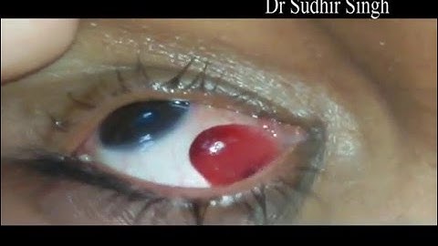 Conjunctival Pyogenic Granuloma Excision Video Under Topical Anesthesia #122