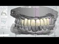 3shape designanterio teeth articulator implant case  3shape     