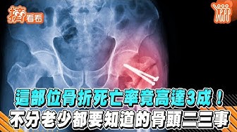 骨折 Youtube