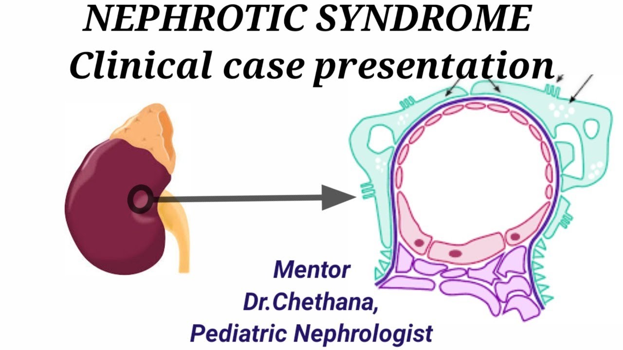 NEPHROTIC SYNDROME Clinical Case Presentation
