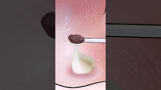 Asmr Refreshing Blackhead Removal And Ear Cleaning Animation Asmr