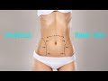 Mini Tummy Tuck Cost Ontario Mini Tummy Tuck Cost Ontario