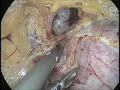 Large cervical fibroid  total laparoscopic hysterectomy