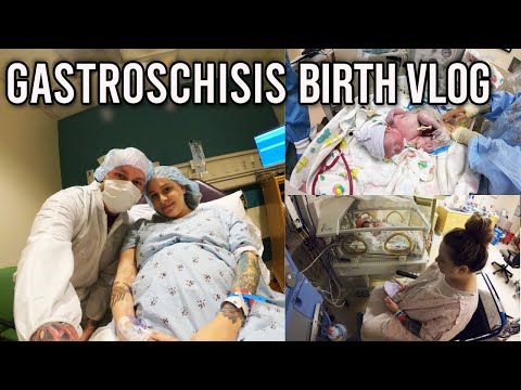 GASTROSCHISIS BIRTH VLOG | NICU VLOG | WHAT TO EXPECT GASTROSCHISIS BIRTH & DELIVERY