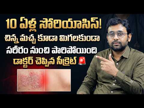 10 ఏళ్ల సోరియాసిస్ 80–90% తగ్గింది! | Psoriasis Treatment & Home Remedies | Dr Chetan Raj | SumanTV
