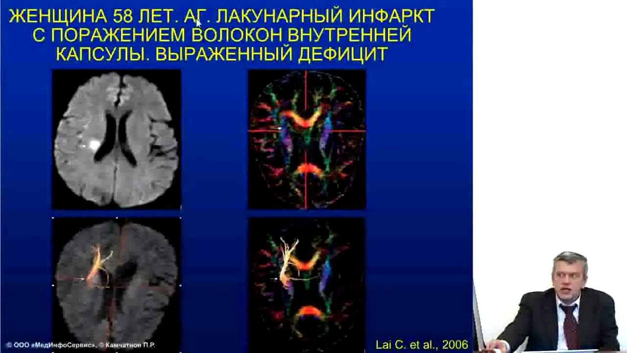 Элькар (левокарнитин) при ишемическом инсульте, д. м. н., проф. П. Р .