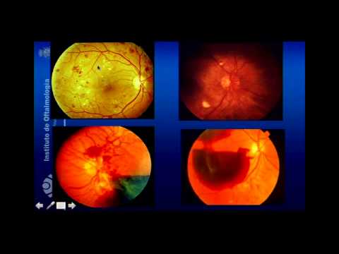 Vídeo: Diseño Y Datos De Línea De Base De Un Estudio Metabonómico Basado En La Población De Enfermedades Oculares En El Este De China: La Investigación De Enfermedades Oculares Yueqing