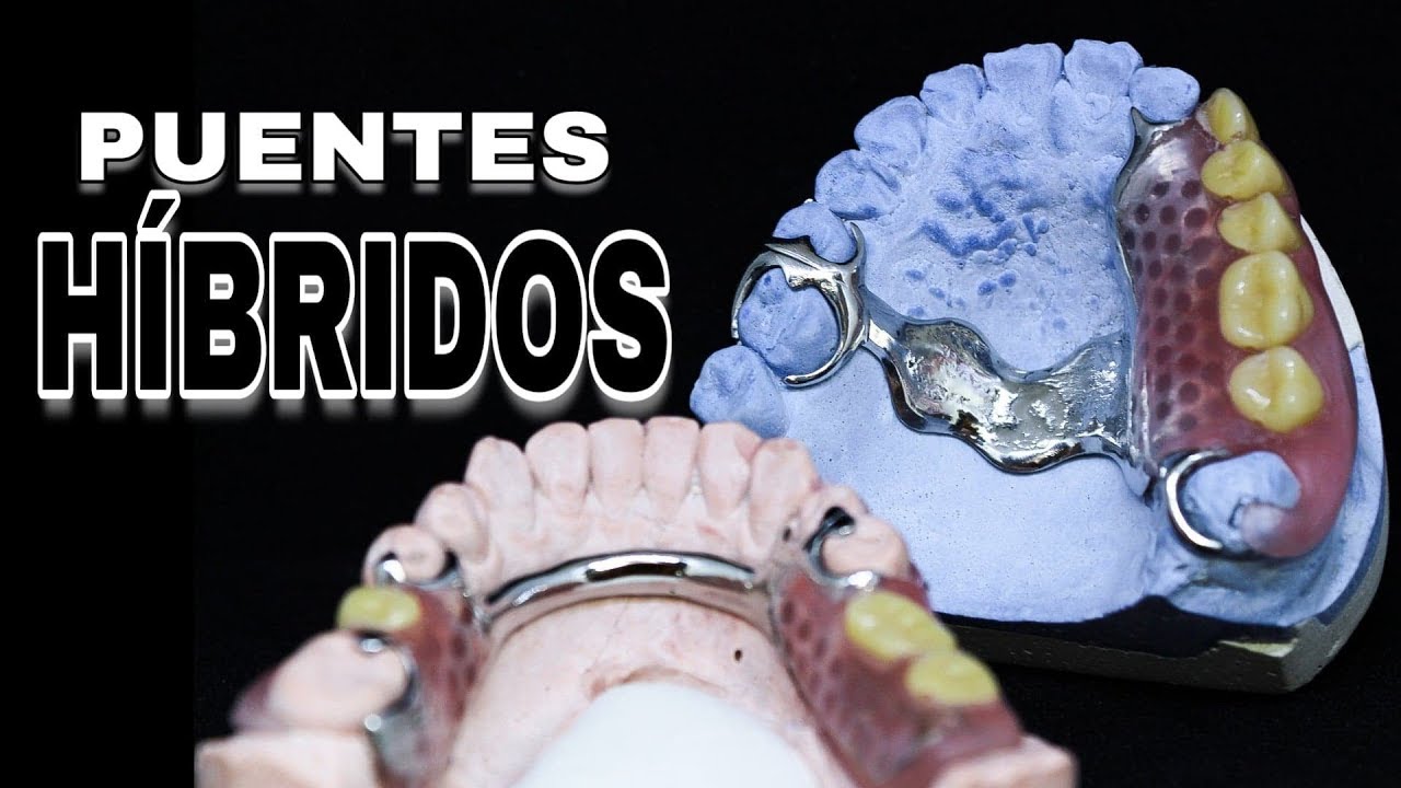 PRÓTESIS HíBRIDAS GENERALIDADES