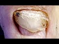 There are big grooves on toenails, foot care