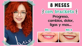 8 MESES CON BRACKETS 😁 PROGRESO, DOLOR, LIGAS | MI EXPERIENCIA | Mirem Itziar ❤