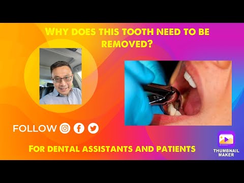 Video: Paano Magagamot ang isang Broken Tooth (na may Mga Larawan)
