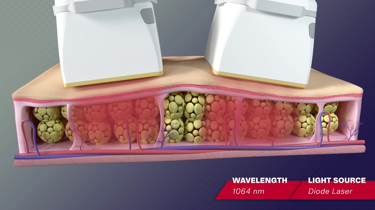 VENUS BLISS - 1064 DIODE LASER FAT REDUCTION