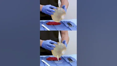 I Got A BOOB JOB 🍊🍊 Dr. Johnson C.  Lee | Beverly Hills, CA