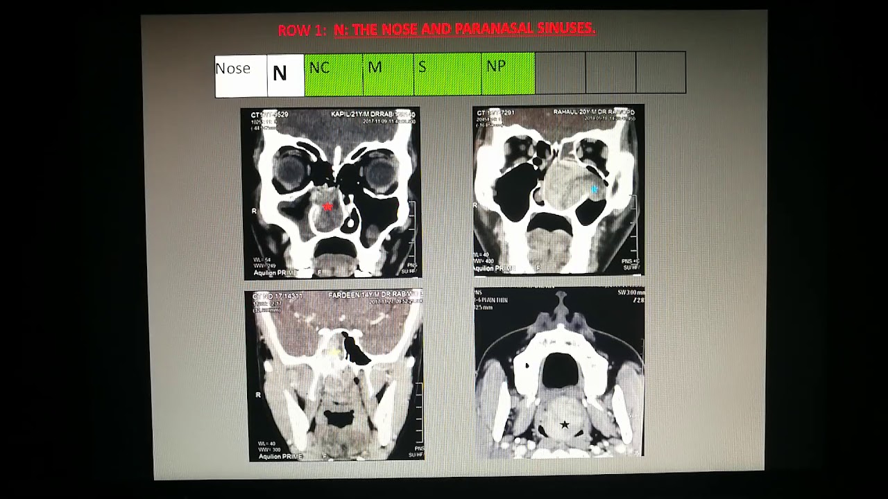 Angiofibroma grid by Dr Renuka Bradoo