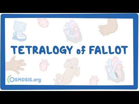 ቪዲዮ: Tetralogy of fallot አለው?