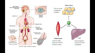 картинка: Diabetes mellitus / Дијабет / Шеќерна болест | Патофизиологија