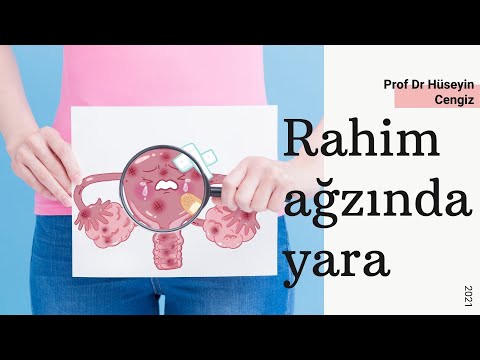 Rahim ağzında yara💥  Tedavisi Gerekli mi? (Rahim ağzı yarası dondurma, yakma işlemi)