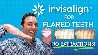 Fix Your Flared Teeth With Invisalign WITHOUT Extractions!