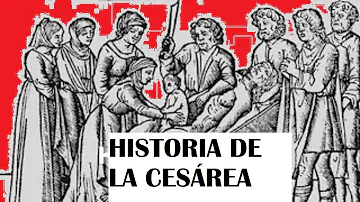 ¿Por qué se llama cesárea?