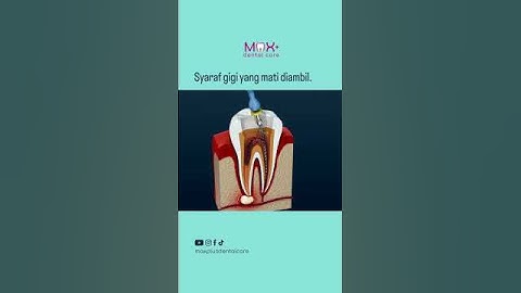 Ilustrasi Perawatan Saluran Akar Gigi
