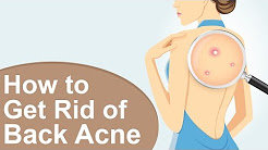 How to Get Rid of Back Acne Fast