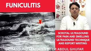 Scrotal ultrasound normal vs abnormal | epididymitis | Funiculitis ultrasound | Hydrocele ultrasound