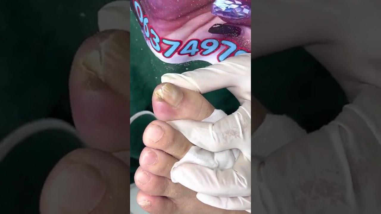 Ep_4382 Ingrown toenail removal 👣 แตะดู..ยังเจ็บไหม 😁 (clip from