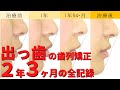 【矯正・Eラインに対する口元の変化・出っ歯】抜歯ワイヤー矯正治療例│上顎前突│ projecting teeth/buckteeth│音声解説付き