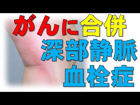 【要注意！】がん患者に多い合併症「深部静脈血栓症」とは？リスクの高いタイプと症状、予防策について