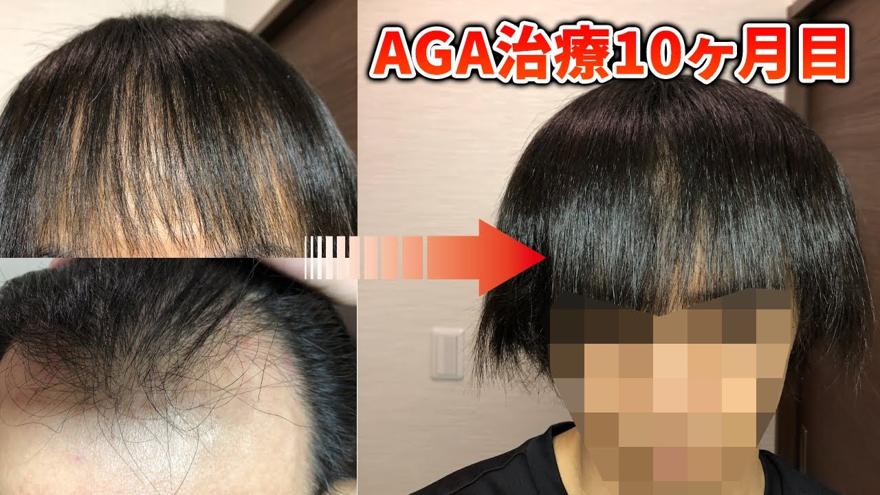 Aga治療10ヶ月目 髪全体の密度が濃くなってきた Youtube