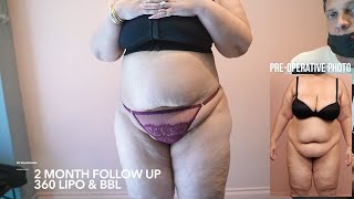 2 Month Follow Up, High Volume 360 Liposuction with Brazilian Butt Lift (BBL)
