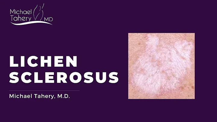 Lichen Sclerosus Treatment