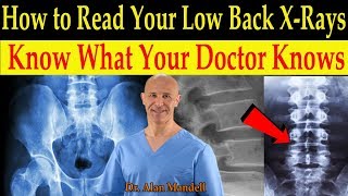 How to Read Your Low Back X-rays (Know What Your Doctor Knows) - Dr. Alan Mandell, D.C.