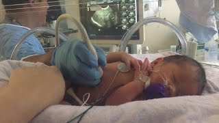 Doctors Repair Baby's Spine While Still in Mother's Womb