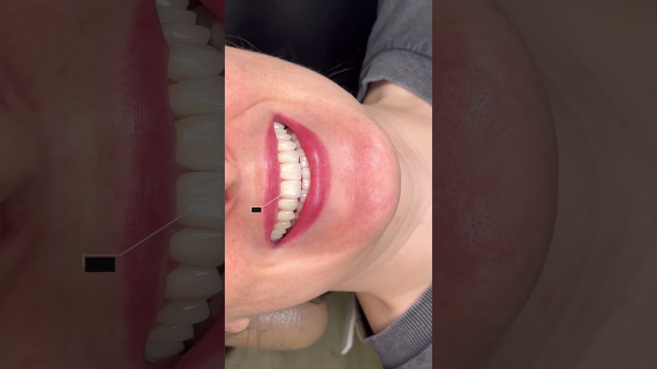 Smile Makeover using Ultra-thin Veneers #dentist #cosmeticdentistry #dentalclinic