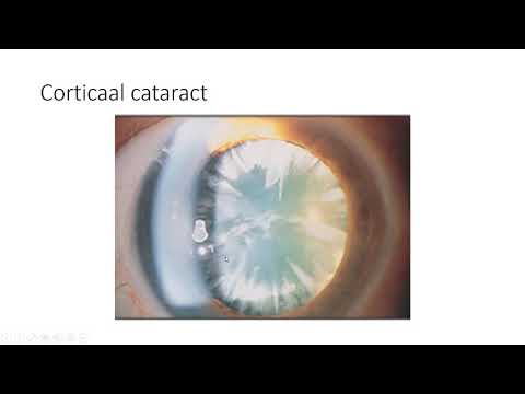 cataract troebeling ooglens