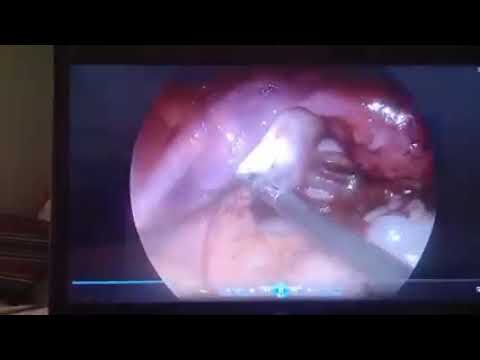 Clinical video 08 thumbnail