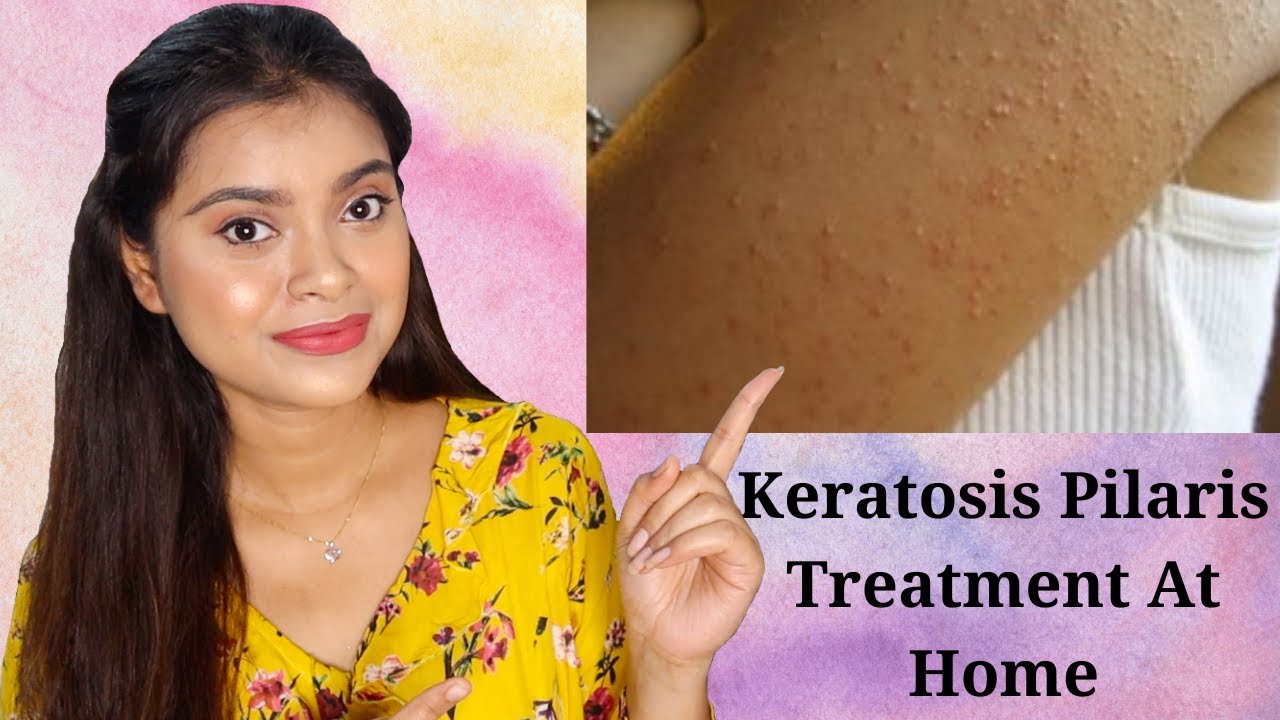 Chicken Skin Treatment Keratosis Pilaris Treatment At Home How To