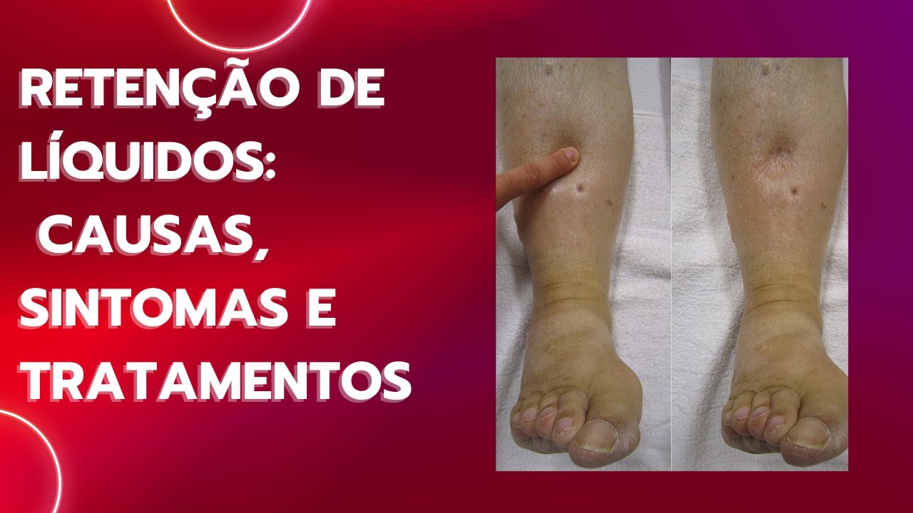 Retenção de Líquidos: Causas, Sintomas e Tratamentos - YouTube