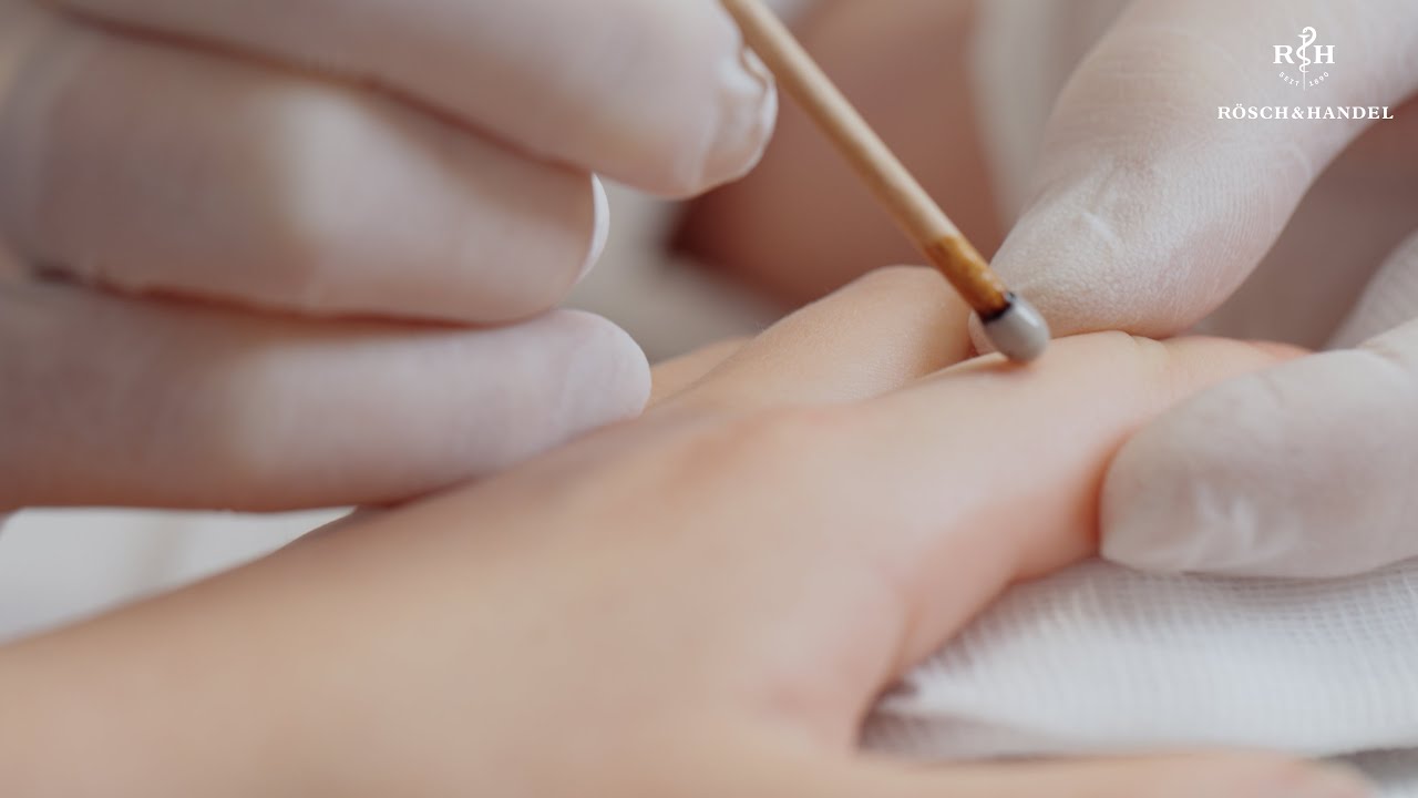 Wart and verruca removal with SILVERIN Silver Nitrate Applicators YouTube