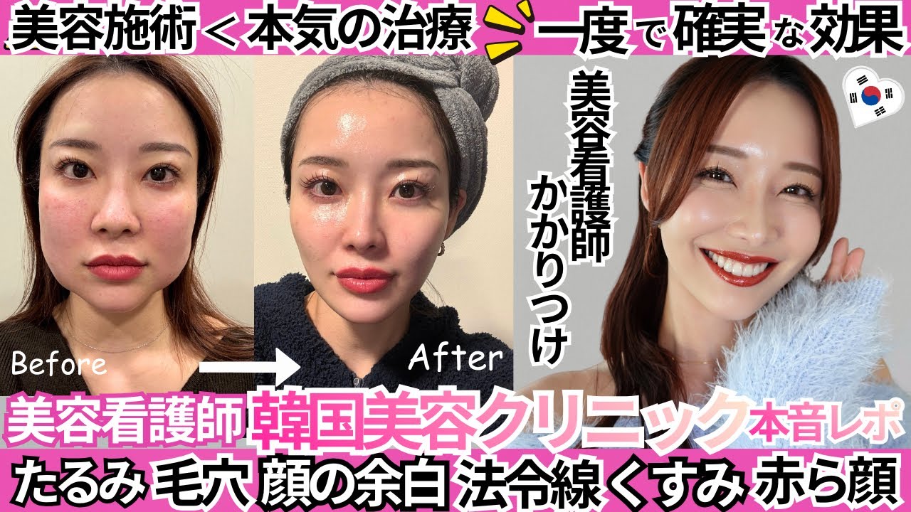 【🇰🇷韓国美容クリニックレポ】本気で肌を治したい人必見⚠️美容施術でなく治療です。日本人スタッフ在中。圧倒的効果の小顔治療、美肌治療、毛穴改善、リフトアップ治療。
