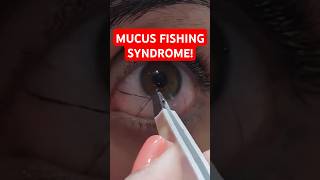 What Is Mucus Fishing Syndrome? How To Stop It!