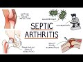 Understanding Septic Arthritis Understanding Septic Arthritis